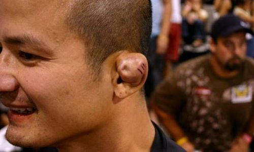 Cauliflower Ear 101- Causes, Treatment, and Tips For Prevention cauliflower ear bjj