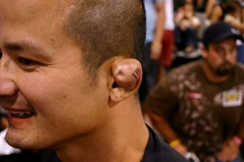 cauliflower ear bjj